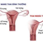 Trứng sau khi được thụ tinh gặp vấn đề bất thường khiến trứng bị kẹt lại ở ống dẫn trứng là nguyên nhân gây ra hiện tượng chửa ngoài dạ con